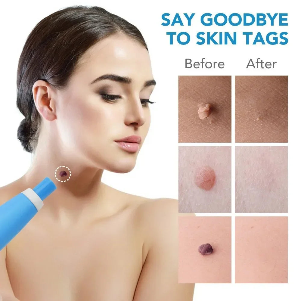 A woman is shown using a blue device to remove skin tags, demonstrating before and after results.