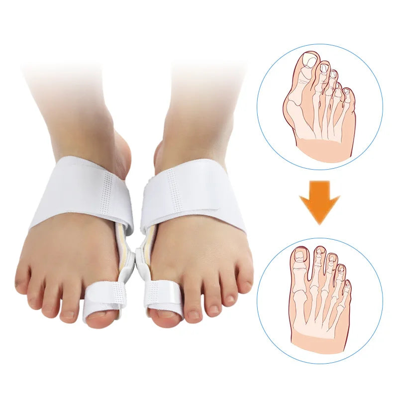 White silicone corrector device shown on a foot, illustrating proper big toe alignment.
